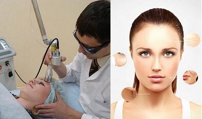 كيف يتم تجديد الجلد بالليزر؟